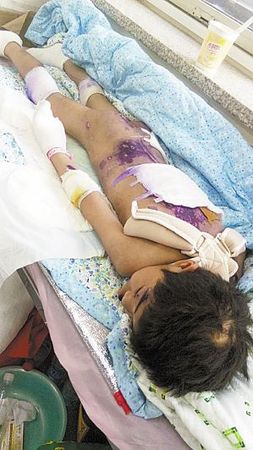 遭虐待遍体鳞伤的彤彤。本报记者 汪洋 摄