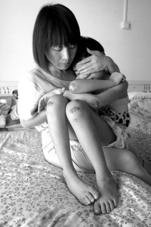 　女童的外伤基本痊愈，但留下了明显的疤痕。京华时报记者蒲东峰摄