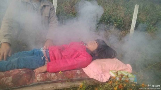 火熏治疗6