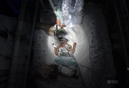 婴儿只有660克重、28公分长，跟一根筷子的长短差不多。因为妈妈的胎盘前置，她便迫不及待的来到了这个世界，比足月出生早了15周。