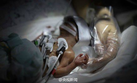 重庆筷子宝宝离世 中国最小早产婴仅活19天(图)