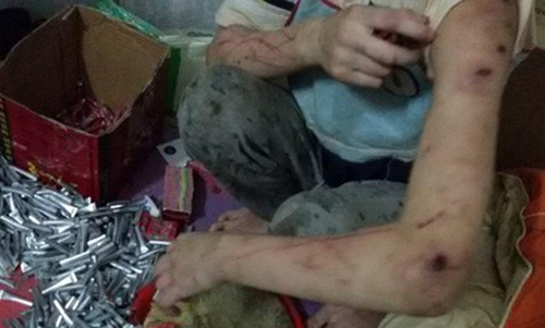 两个孩子遍体鳞伤，浑身都是斑斑点点的淤青和伤痕，从手到脚、前胸后背、大腿、腹部几乎找不到一块好皮肤。小琳的右脸颊还有一大片延至眼窝的淤青，左脸颊下侧和两条手臂则是横七竖八的血痕和血痂，惨不忍睹。