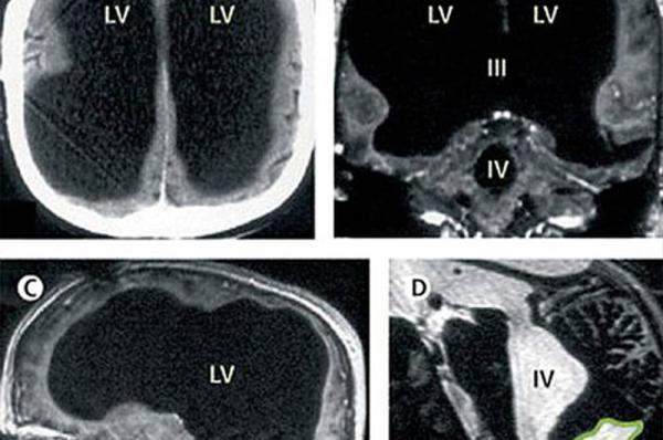 法国男子腿疼就医却被查出大脑已消失过半体积