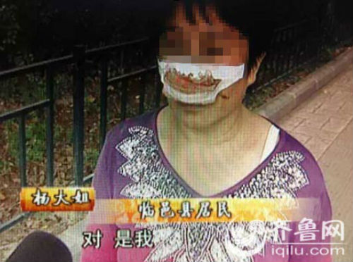 杨大姐自称来自德州临邑，鼻子是被丈夫一口咬掉的。（视频截图）