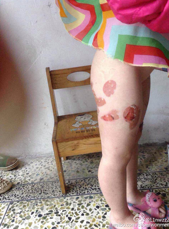 温州4岁女童遭禽兽父亲虐待 双腿多处被灼烫流脓