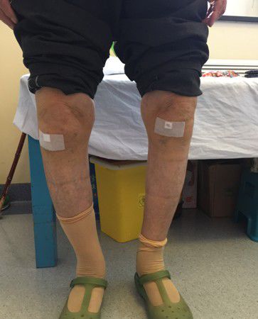 膝关节问题的根本是“肝肾亏虚”？