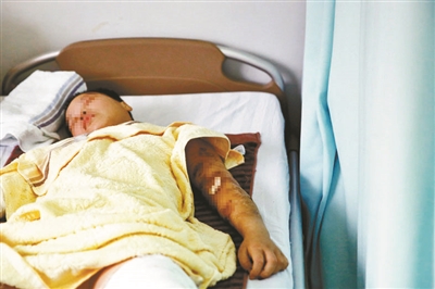 四肢被咬伤的李娟至今仍躺在病床上供图/CFP