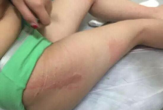 搓澡工拿错搓澡醋精搓身 致女顾客被烧伤 搓澡工拿错搓澡醋精搓身 致女顾客被烧伤