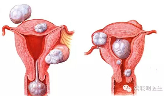 龚晓明：1/3女性都有的子宫肌瘤到底是啥