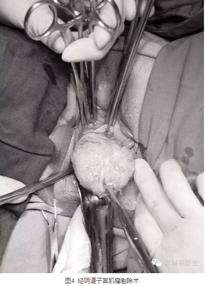 龚晓明：1/3女性都有的子宫肌瘤到底是啥