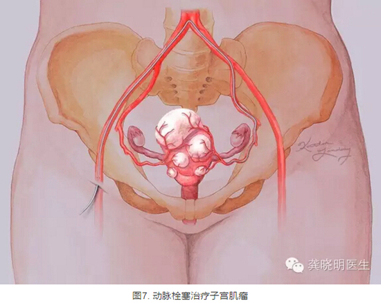 龚晓明：1/3女性都有的子宫肌瘤到底是啥