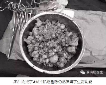 龚晓明：1/3女性都有的子宫肌瘤到底是啥