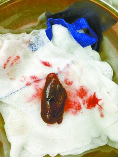 正常的甲状旁腺只有黄豆大，切下来的瘤子有金丝小枣大。