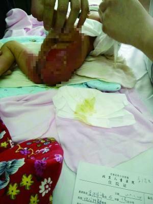 新生儿医院洗澡被烫伤未处理 当事护士暂时停职