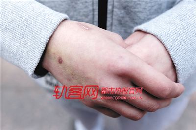 　张燕每天都要隔绝打架的豪猪，白嫩的双手如今全是伤口