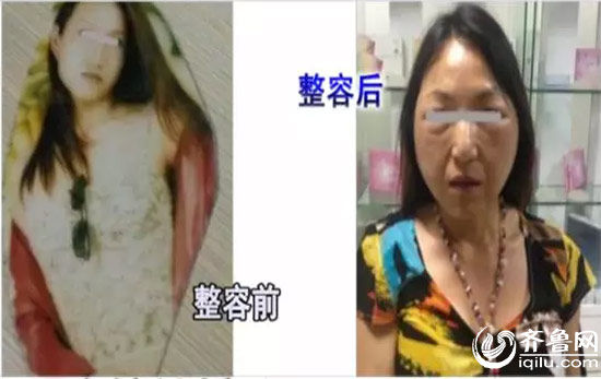 微整后脸部浮肿变形（视频截图）