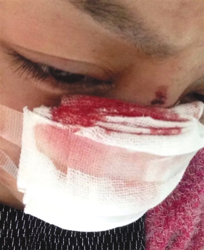 　李云鼻子被割后仍在治疗。网络截图
