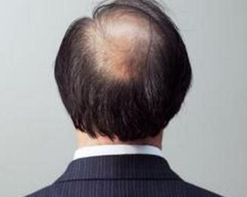 肾虚致脱发 掉发严重如何洗头？