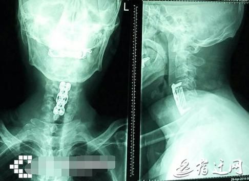 53岁大伯仰头喝可乐突然四肢瘫痪