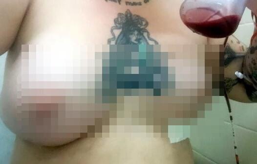 英国一名女子去隆乳，从A罩杯升级到F罩杯，没想到一周后左胸竟然“泄气”。