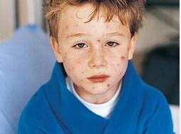 小儿皮肤娇嫩 夏季如何防小儿皮肤病