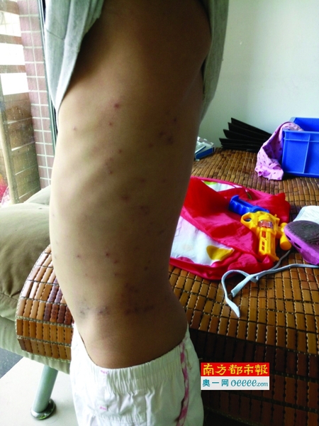 陈俊皓身上起了不少红疙瘩，奇痒无比