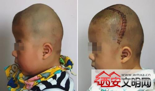 男婴小宇（化名）患有严重的狭颅症