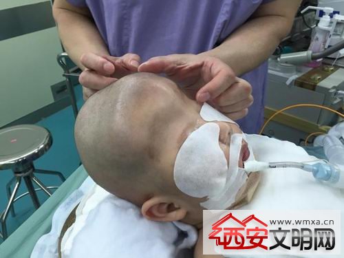 男婴小宇（化名）患有严重的狭颅症