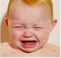 看中医解读湿疹的原因及治疗方法