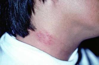 为什么年轻人也会得“带状疱疹”？