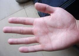 看手掌便知高血压？如何调理防治高血压