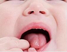 口腔溃疡怎么办？中医偏方助你摆脱困扰