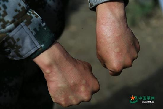 虽然戴着防蚊帽，穿着防护服，但巡逻回来，官兵的手上仍被蚊子叮起好多包。
