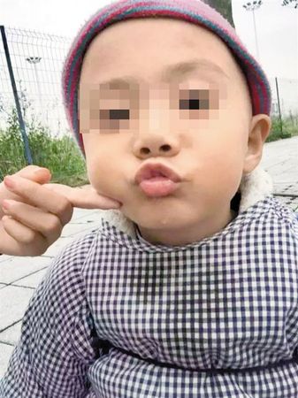 自闭儿尸检结果