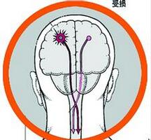 运动保健 两脚画圈让你远离脑中风