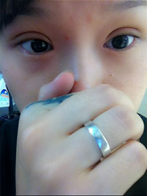 割双眼皮后热敷还是冷敷好？