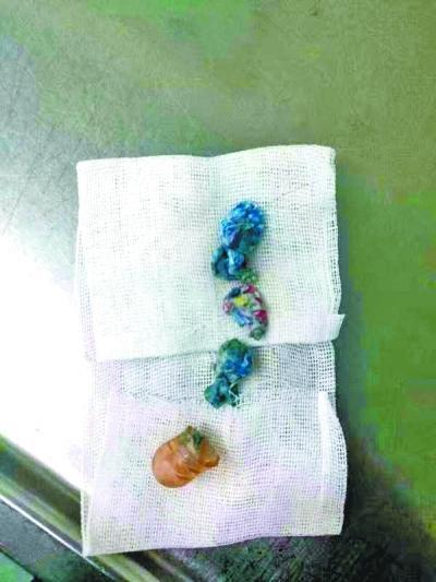 2岁女童吃什么吐什么 胃中掏出一团纸屑半个奶嘴