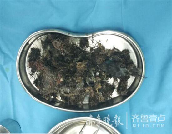 青岛女童妙妙（化名）今年5岁了，最近一段时间，妙妙的父母发现女儿经常喊肚子疼，于是夫妻俩就带着女儿到青岛的各大医院就诊，但是一直没检查出原因。8月初，妙妙在爸爸妈妈的陪同下来到青岛市妇女儿童医院外科门诊就诊。