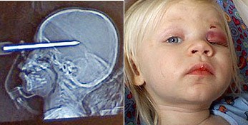 刀插入英国小女孩的左眼，奇迹生还