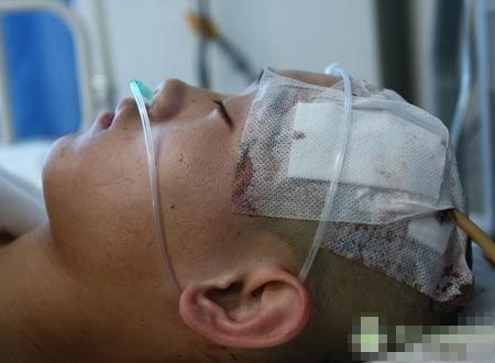 男孩与人争执，尖刀插入太阳穴