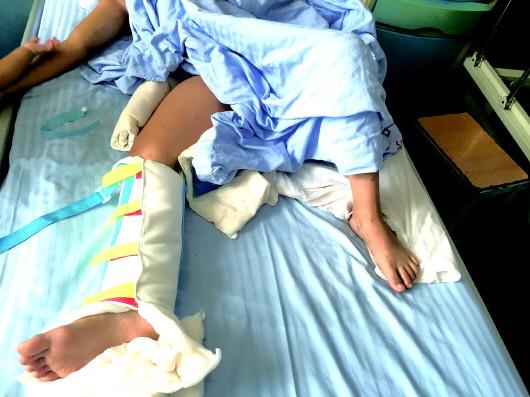 7岁女孩三楼坠下致骨折 家长称其遭玩伴推下