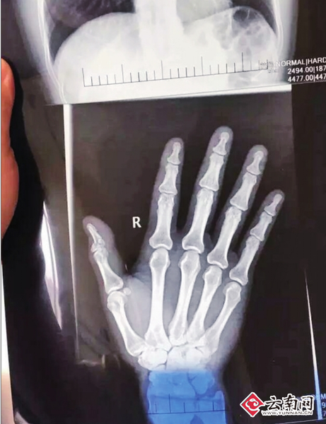 网曝老师帮女儿发小广告被小区保安群殴手指骨折物管：是他自己摔倒