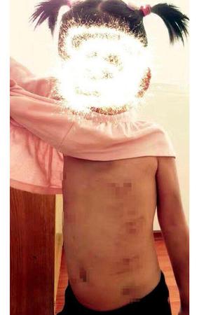 江苏一4岁女孩遭恶性虐待浑身是伤 警方调查