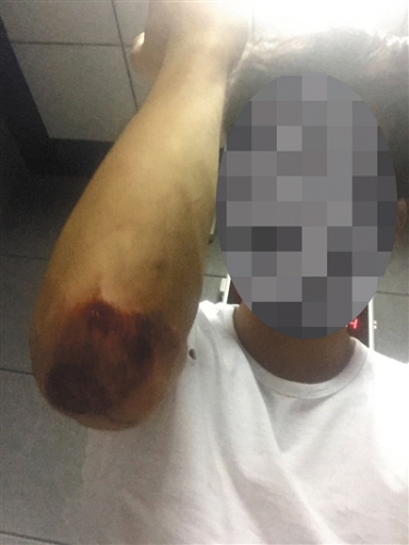 被警方抓捕时，不知情的黄诚进行了反抗，导致胳膊肘擦伤。