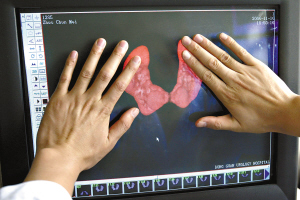 双肾相连长成马蹄肾3