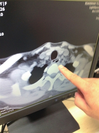 6厘米长鱼刺体内游荡