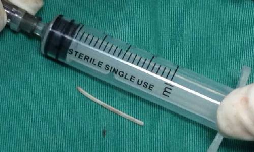 6厘米长鱼刺体内游荡3