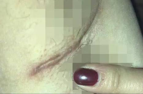 女子花两万隆胸伤口腥臭