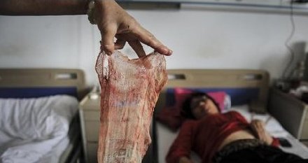 剖腹产月余体内现纱布