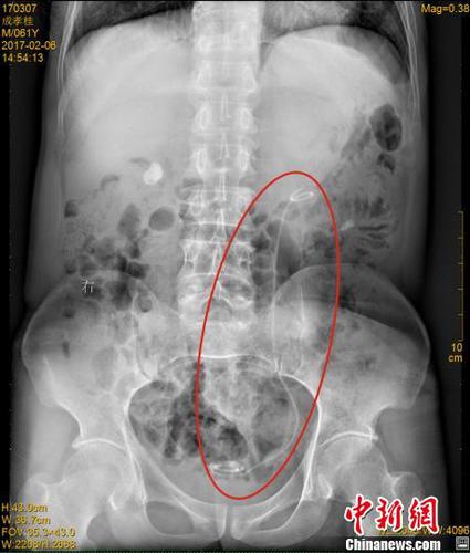四川一男子体内藏30厘米医用导管七年浑然不知（图）